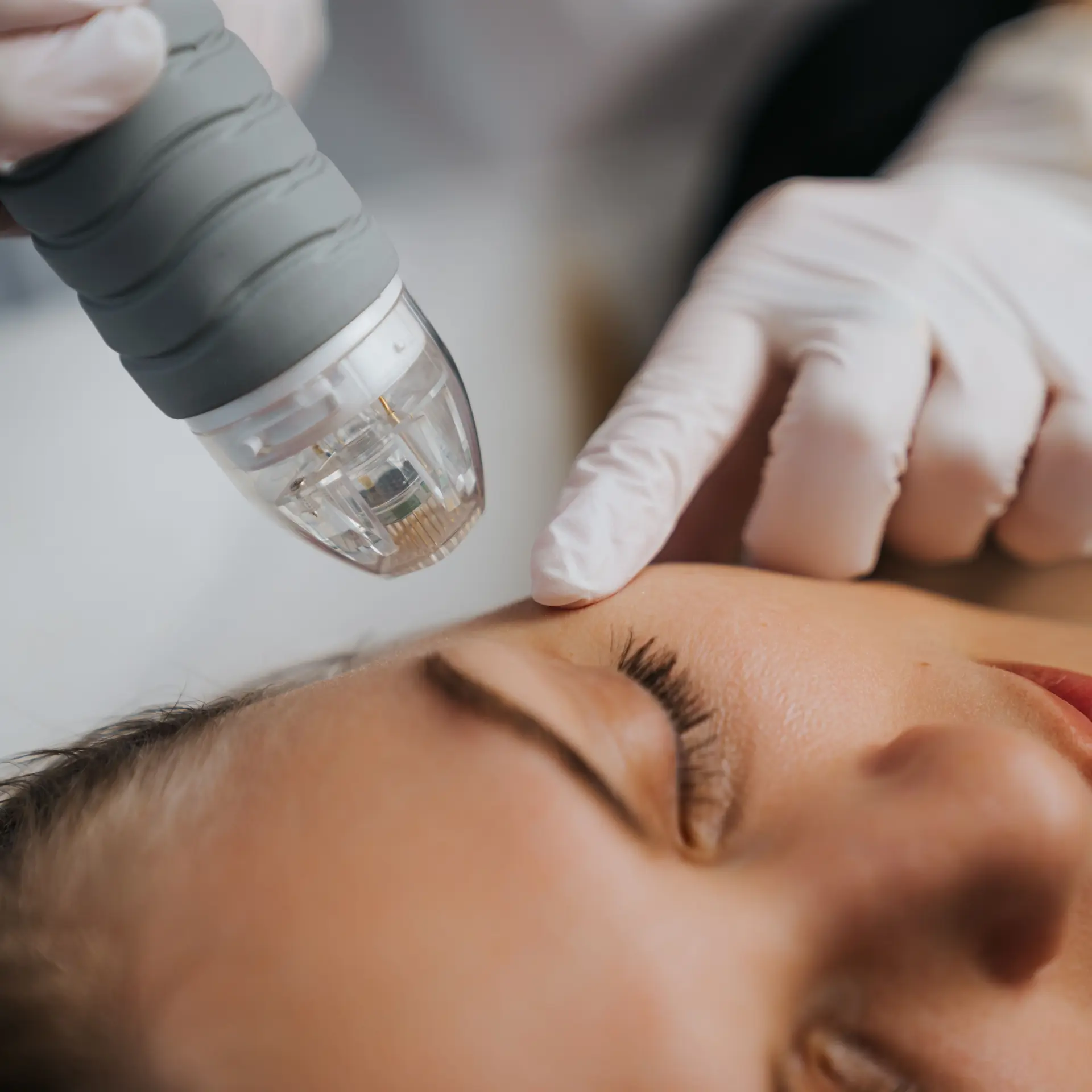 A beauty Professional using a Microneedle RF machine on a customer in a beauty saloon